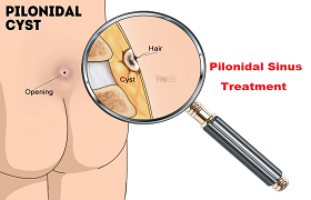 Pilonidal cyst - Symptoms and causes - Mayo Clinic