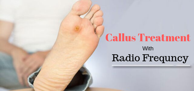 Hand and Foot Callus Treatment & Removal