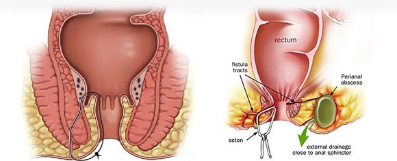 With perianal fistulas